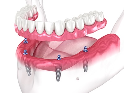 Illustration of full denture being attached to All-on-4 implants in Encinitas, CA