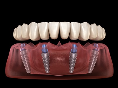 Illustration of All-on-4 dentures and dental implants against black background