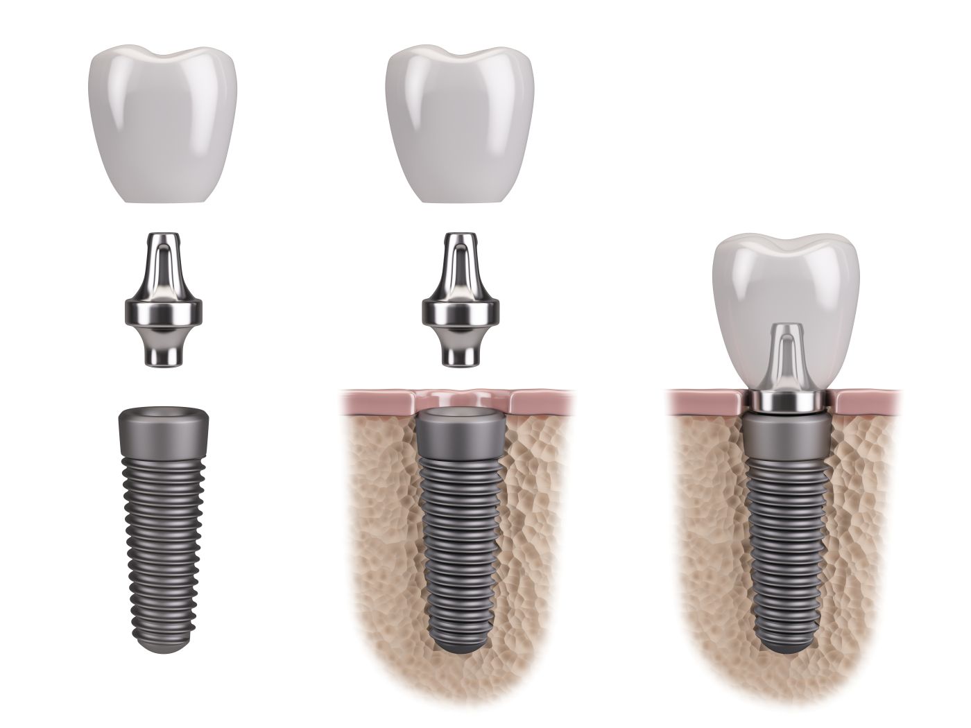 How a Dental Implant’s Materials Affect its Lifespan | Dr. Greg McElroy